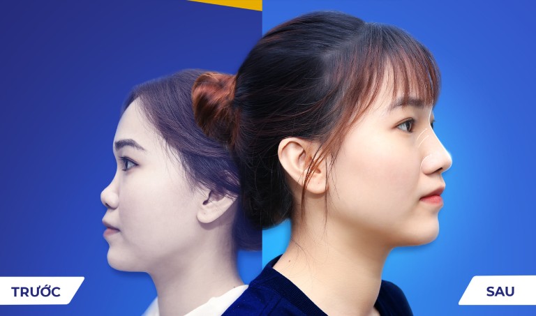 Thẩm Mỹ Viện Ngọc Dung là địa chỉ nâng mũi tại Bà Rịa - Vũng Tàu chất lượng