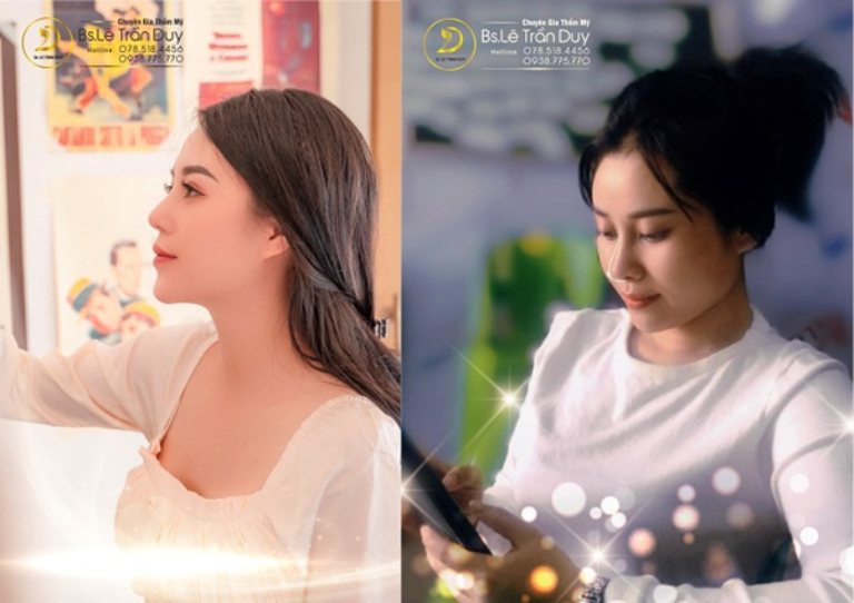 Địa chỉ nâng mũi đẹp tại Bình Tân