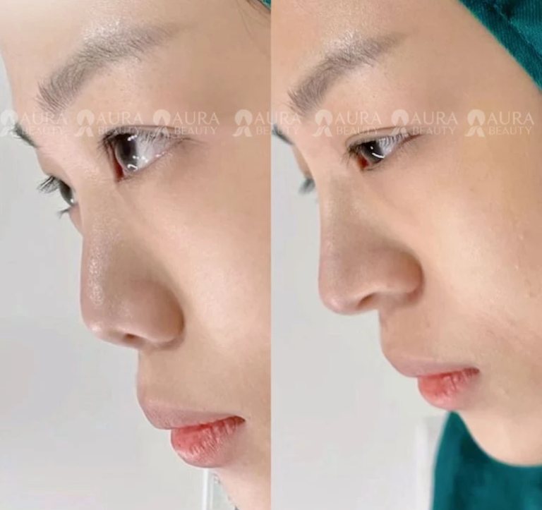 Thẩm Mỹ Viện Nâng Mũi Tại Cà Mau Aura