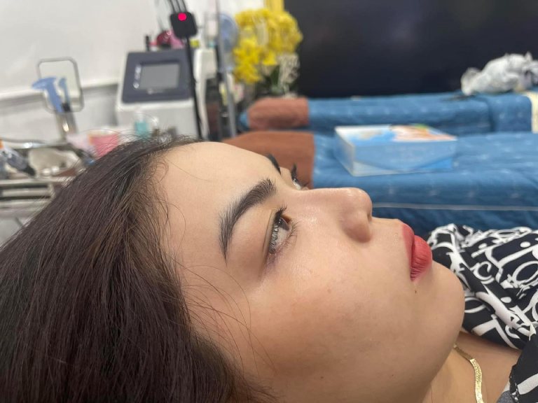 nâng mũi tại Thẩm Mỹ Viện Thành Công Cà Mau