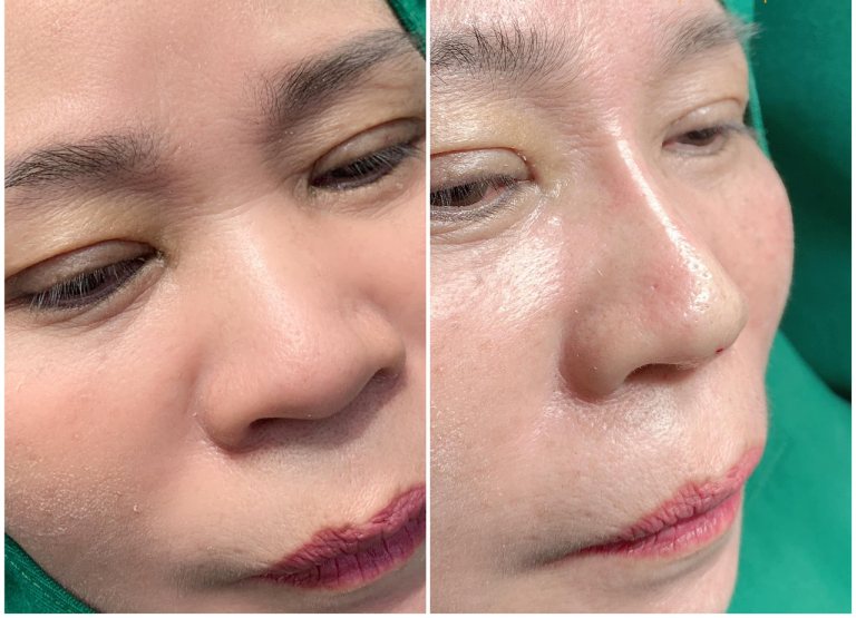 nâng mũi tại Mỹ Uyên Spa Cà Mau