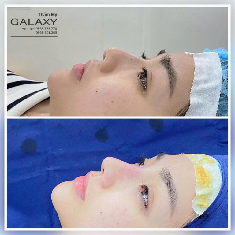 Địa chỉ nâng mũi ở Cà Màu