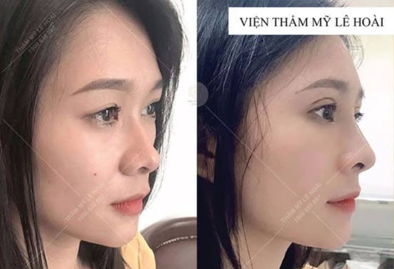 Thẩm Mỹ Lê Hoài nâng mũi tại Củ Chi