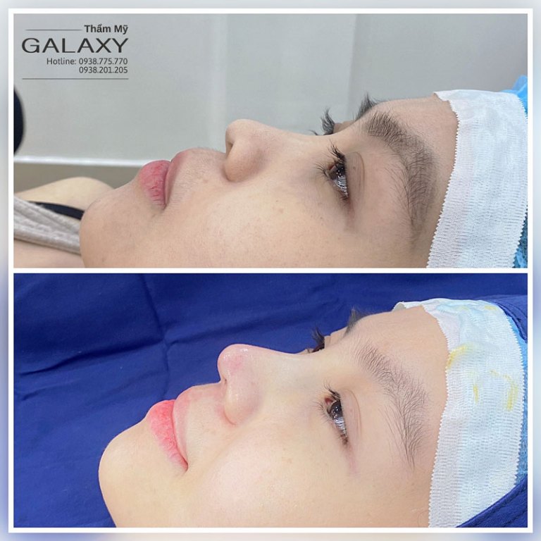Thẩm mỹ Galaxy nâng mũi cho khách hàng ở Củ Chi