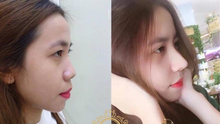 Victoria Spa & Beauty chuyên nâng mũi tại Đồng Tháp