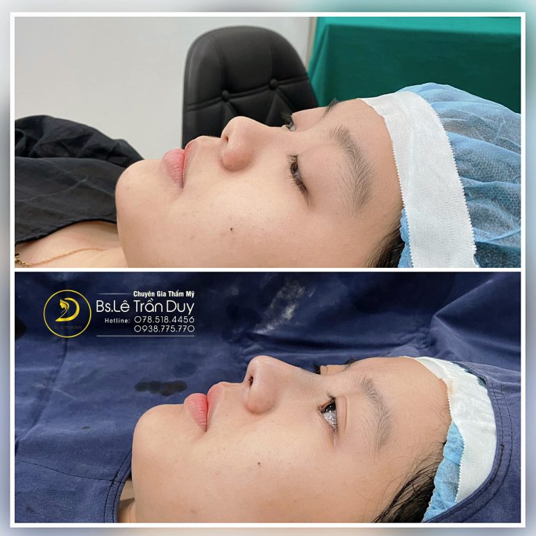 Địa chỉ nâng mũi đẹp tại Quận 10 Thẩm mỹ Bác sĩ Lê Trần Duy