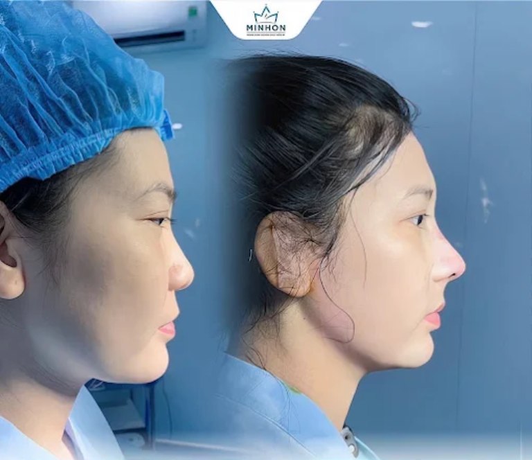 Phòng Khám Chuyên Khoa Thẩm Mỹ Minhon nâng mũi tại quận 7