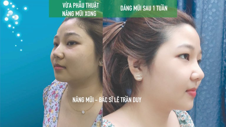 địa chỉ nâng mũi ở quận 7