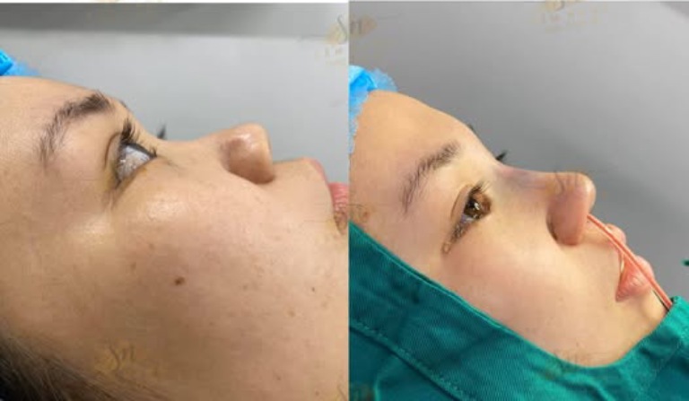 Viện Thẩm Mỹ Sầm Nana nâng mũi ở quy nhơn