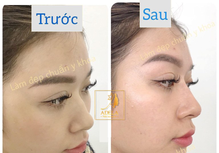 Thẩm mỹ viện nâng mũi tại quy nhơn Adela