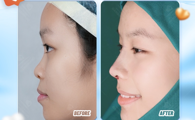 Bệnh viện Thẩm mỹ Gangwhoo nâng mũi đẹp tại quận Tân Bình