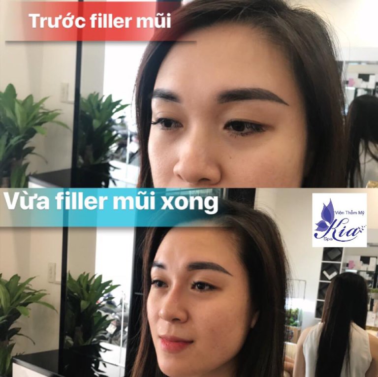Kia Spa nâng mũi tại quận Tân Phú