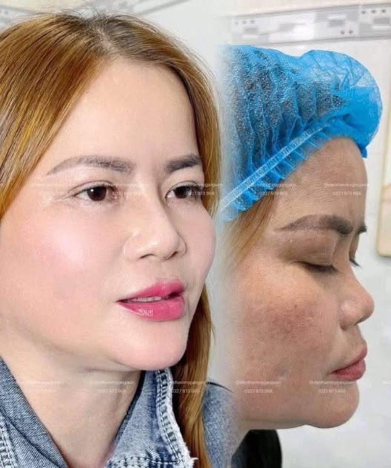 Viện Thẩm Mỹ GangWon nâng mũi tại Tiền Giang