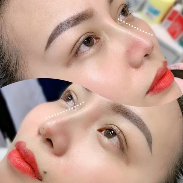 Thẩm Mỹ Viện Quốc Tế Aura nâng mũi tại Tiền Giang