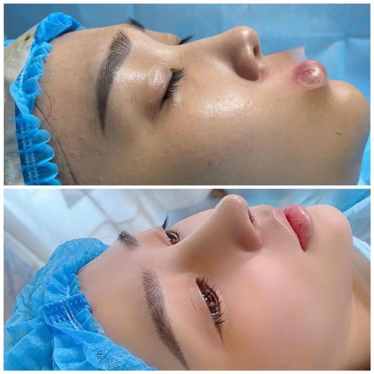 Thẩm Mỹ Viện Minh Nhàn nâng mũi đẹp tại Tiền Giang