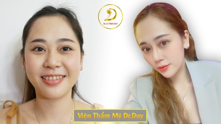 Địa chỉ nâng mũi ở Tiền Giang