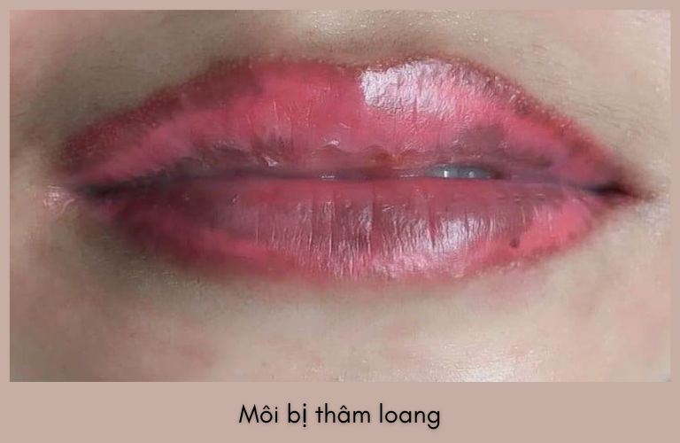 Môi bị thâm loang