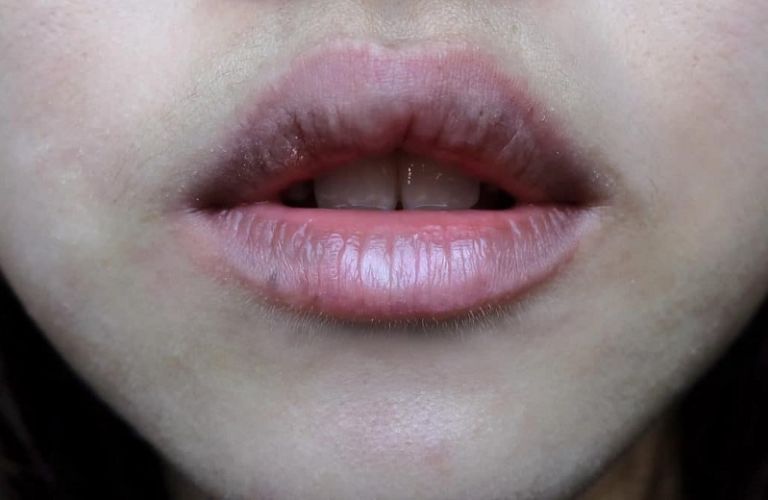 Ảnh hưởng đến thẩm mỹ
