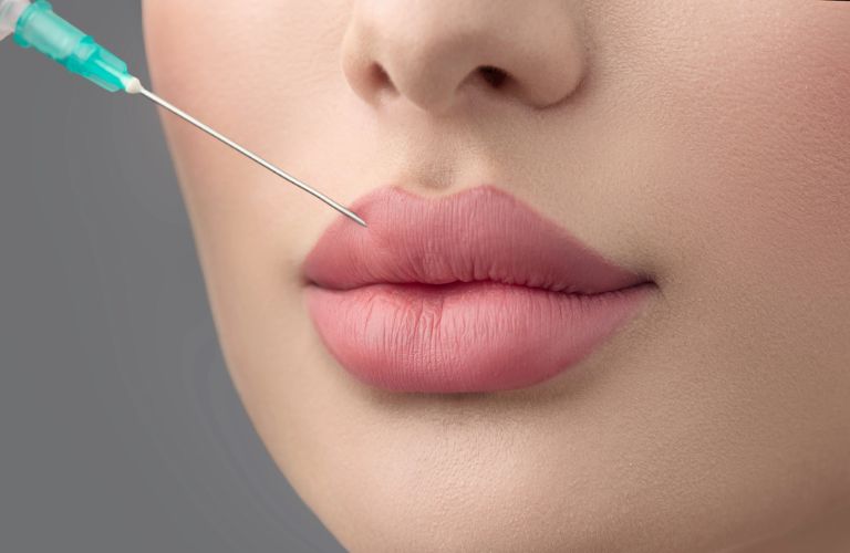 Tiêm filler môi thường được sử dụng để tạo hình môi tều