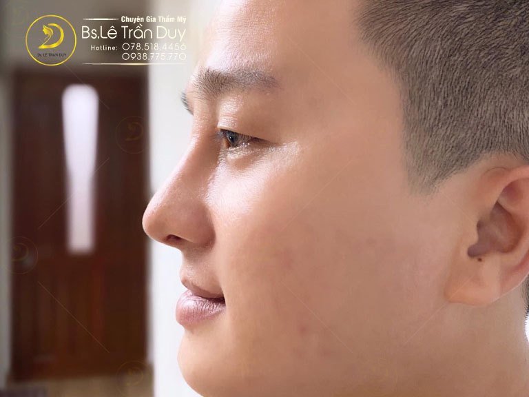Bác sĩ Lê Trần Duy giải đáp nâng mũi sau bao lâu thì lành