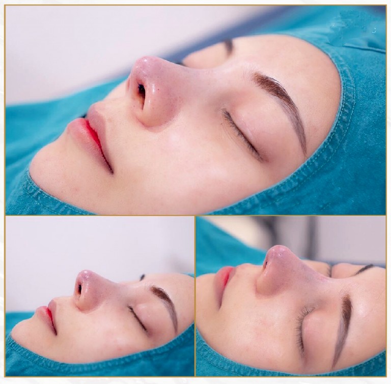 sửa mũi cấu trúc S Line