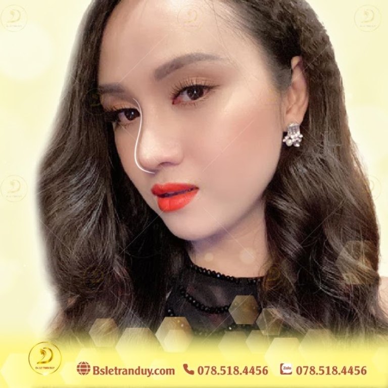 Nâng mũi cấu trúc S line