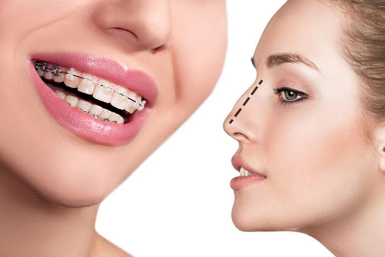 Nâng mũi có niềng răng được không?
