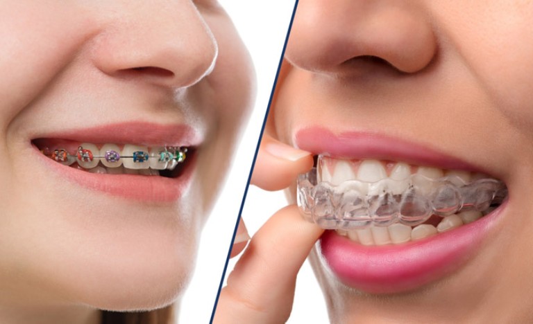 niềng răng có nâng mũi được không