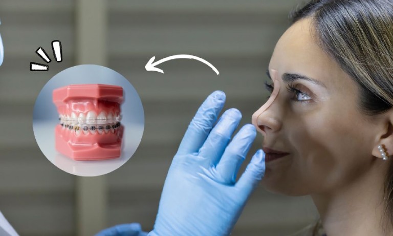 niềng răng có sửa mũi được không