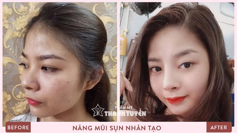 thẩm mỹ viện nâng mũi uy tín tại An Giang