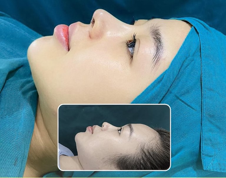 Venus là Thẩm mỹ viện nâng mũi đẹp tại Bạc Liêu