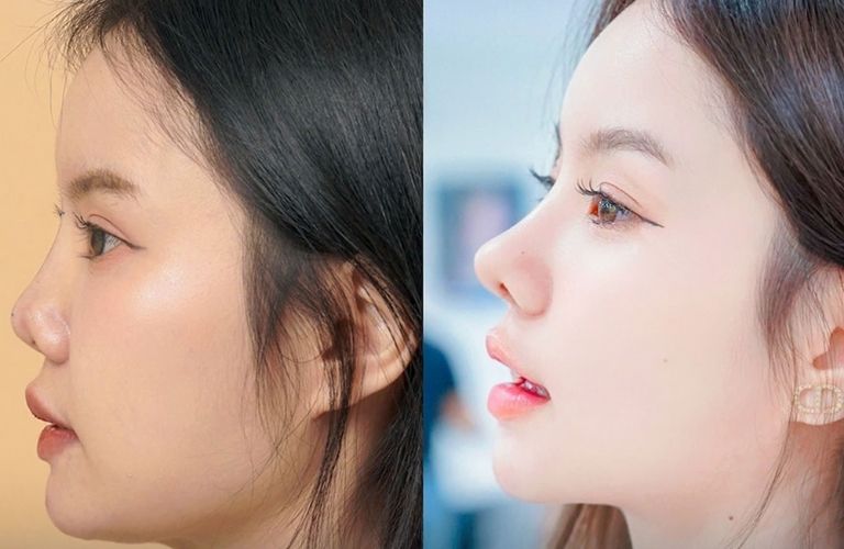Ứng dụng công nghệ nâng mũi tiên tiến