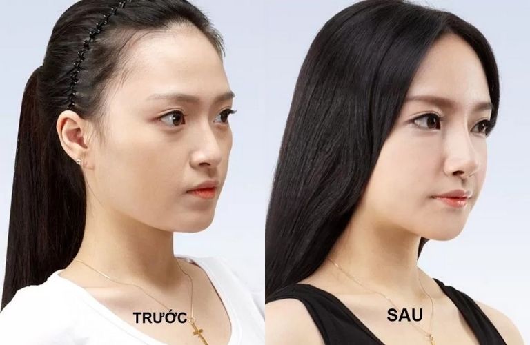 Viện Thẩm mỹ Quốc tế Korea nâng mũi đẹp và an toàn