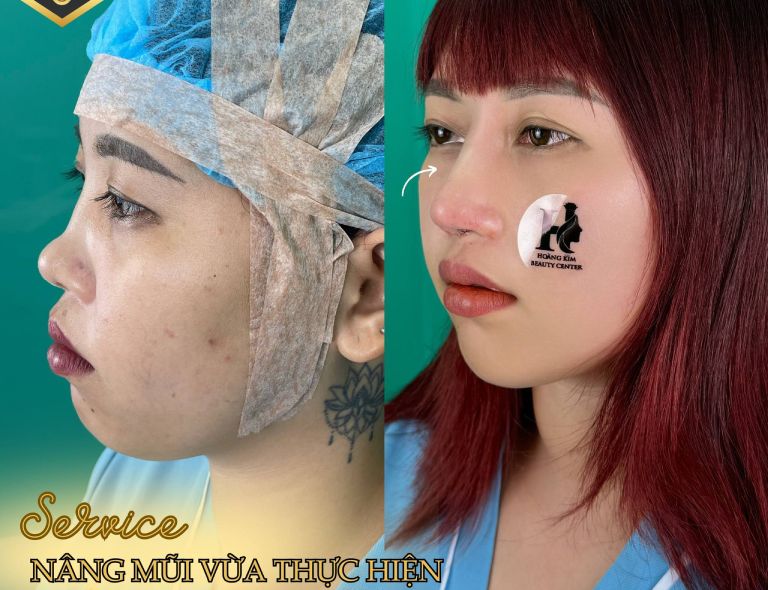 Địa chỉ nâng mũi ở Kiên Giang