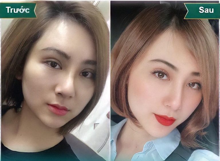 Thẩm Mỹ Viện Hoa Anh nâng mũi đẹp tại Kiên Giang