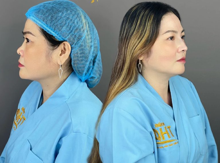 Phòng Khám Thẩm Mỹ HT nâng mũi tại Kiên Giang