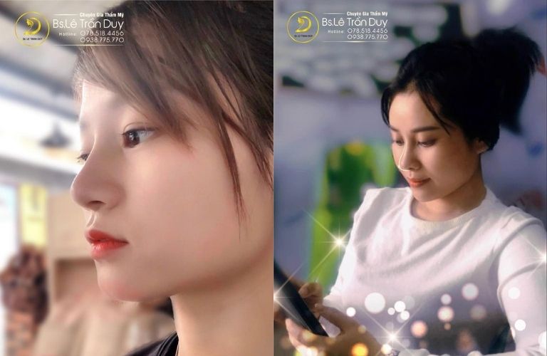 Thẩm mỹ Galaxy nâng mũi đẹp tự nhiên