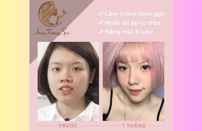Anna Trương làm đẹp gương mặt và nâng mũi với nhiều công nghệ hiện đại
