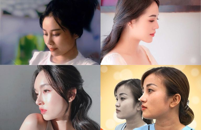 Nâng mũi đẹp tự nhiên tại Thẩm mỹ viện Galaxy