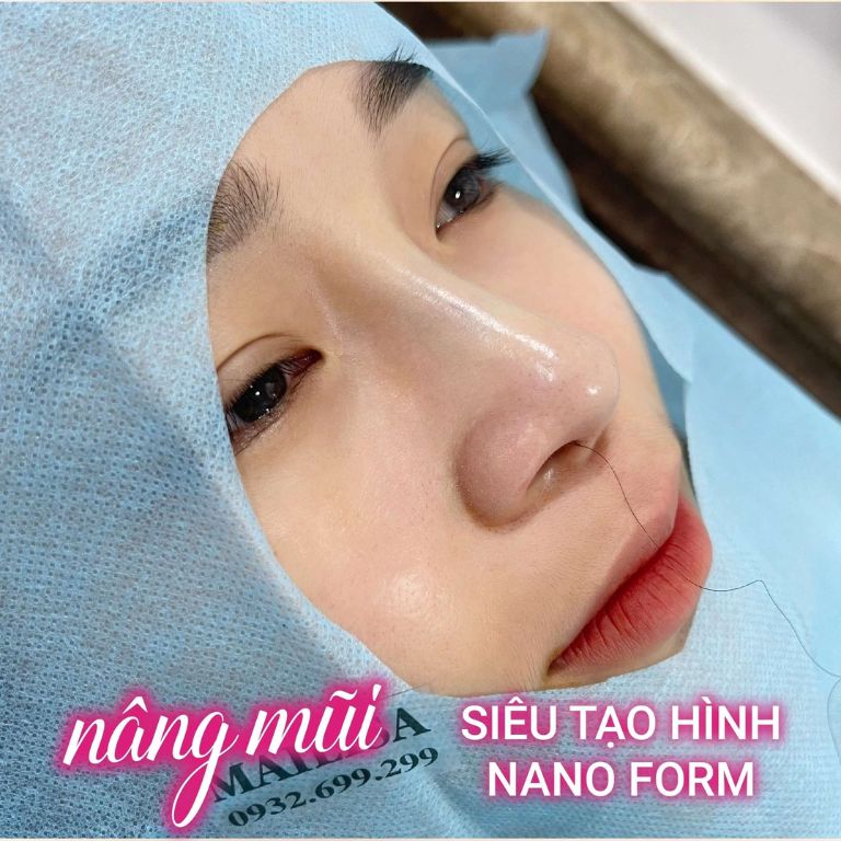 Nâng mũi siêu tạo hình Nano form tại Thẩm Mỹ Viện Mailisa