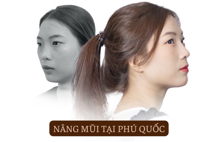 TOP 5 địa chỉ nâng mũi tại Phú Quốc đẹp tự nhiên