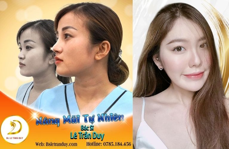 Nâng mũi tự nhiên tại Thẩm mỹ viện Galaxy