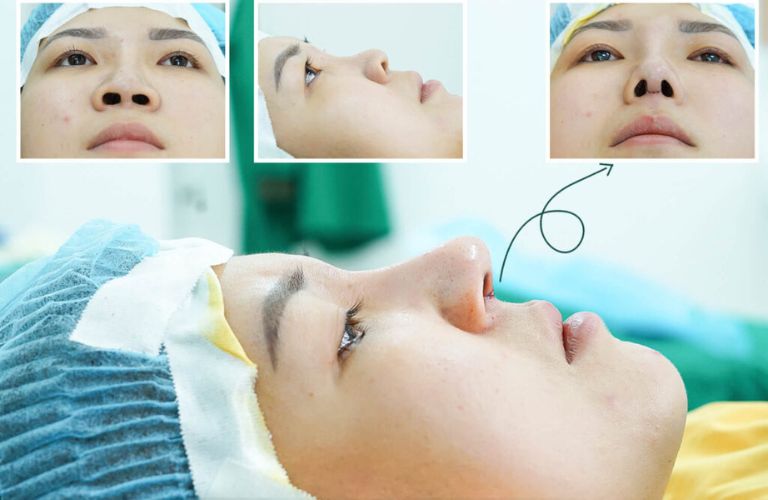 5 Địa chỉ nâng mũi tại Quận 11 an toàn, đẹp tự nhiên