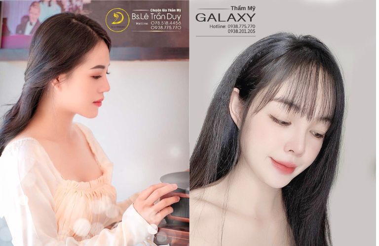Nâng mũi điêu khắc Dr.Duy