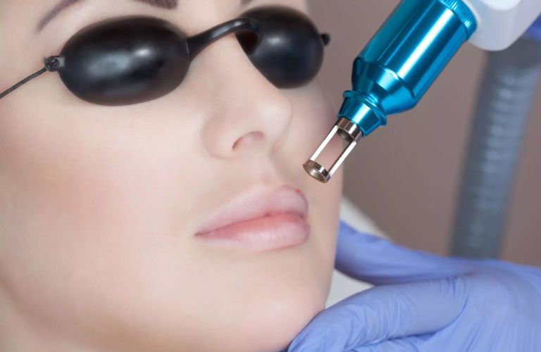 Điều trị thâm môi bằng laser