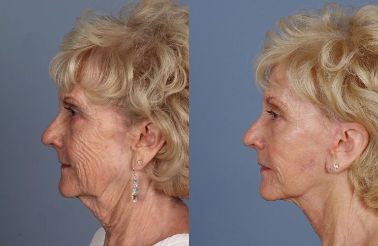 Phẫu thuật căng da mặt