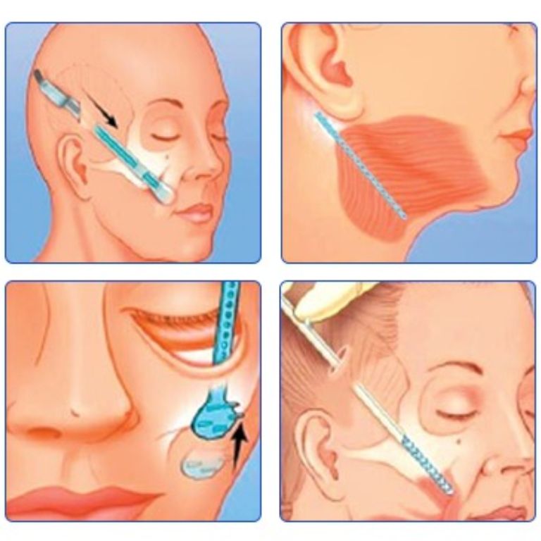 Phẫu thuật căng da mặt nội soi