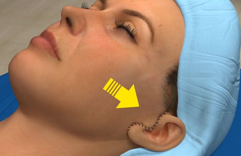 Phẫu thuật căng da mặt bán phần