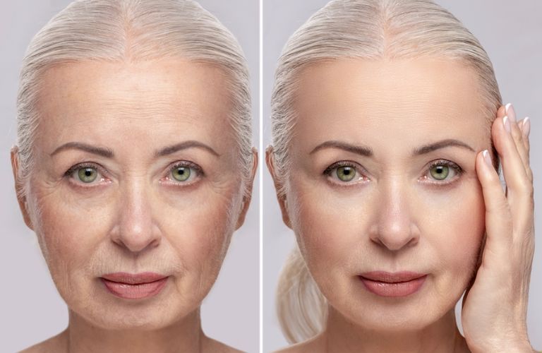 Người từ 35 - 40 tuổi trở lên, da bắt đầu chảy xệ nhiều