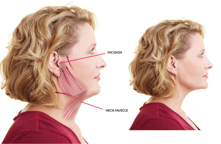 Căng da mặt an toàn nếu được thực hiện bởi bác sĩ chuyên khoa phẫu thuật thẩm mỹ